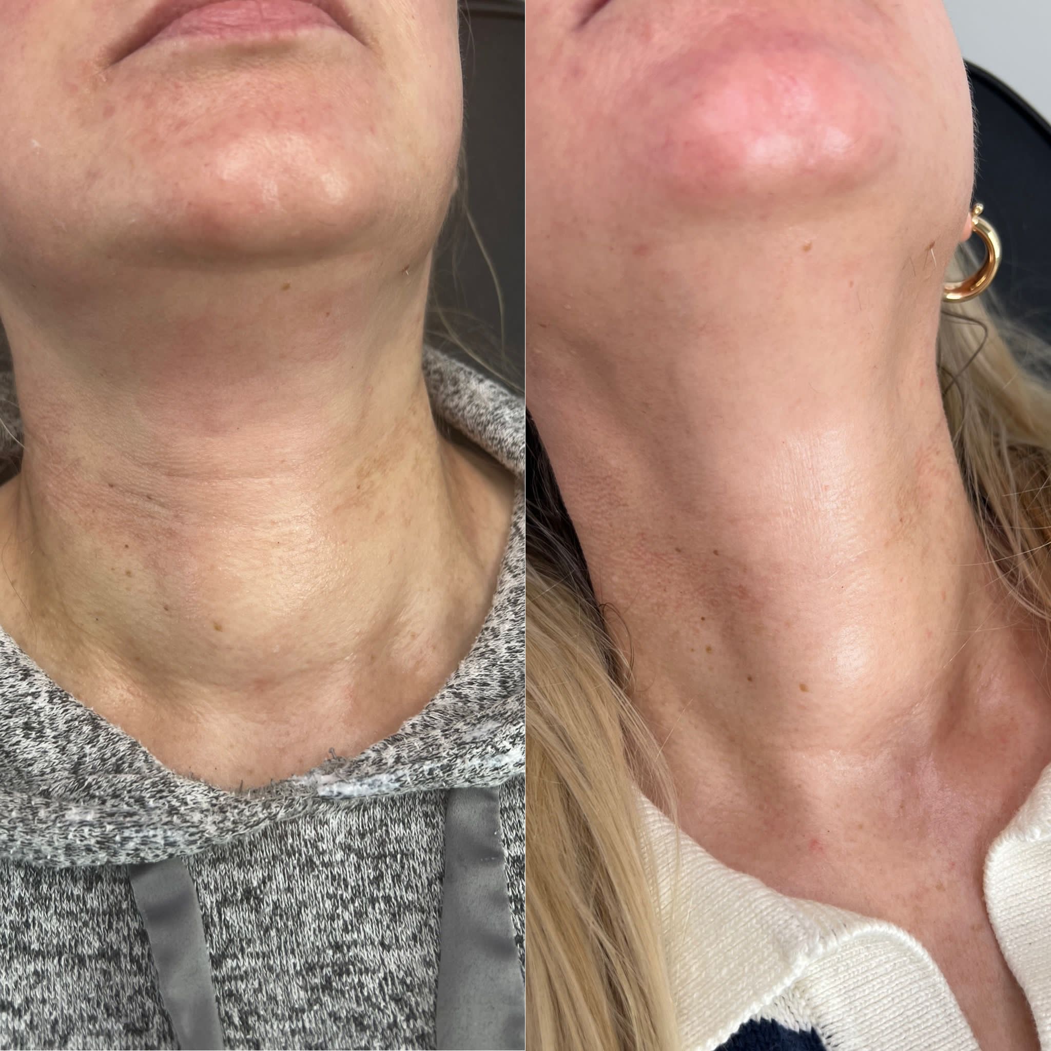 Skin boostyer before and after results on the neck